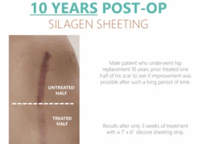 Silagen 2 x 8 strip scar treatment example for hip replacement