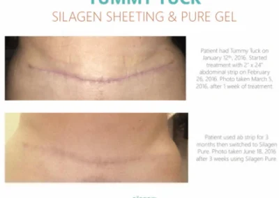 Silagen 2 x 8 strip scar treatment example for tummy tuck