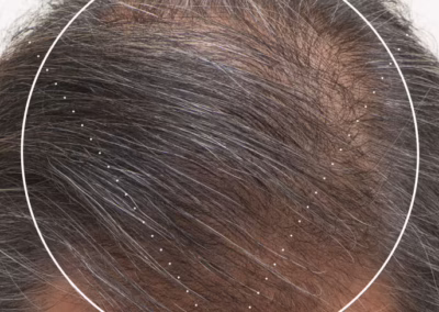 Nutrafol Men Over 50 after picture shows improved hair growth